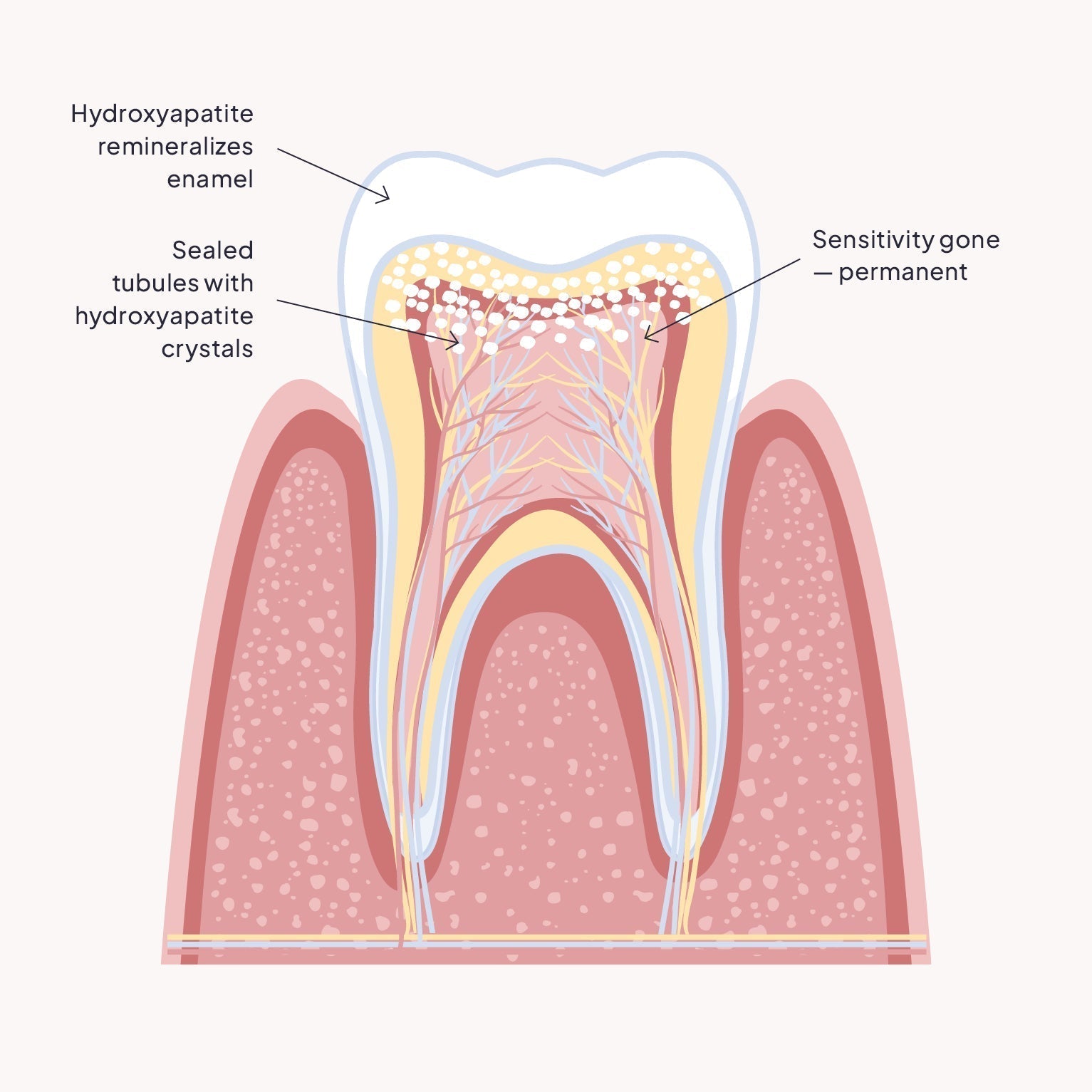 How ENML Reduces Tooth Sensitivity with Hydroxyapatite